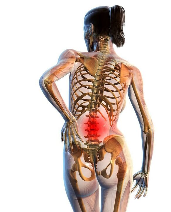 Najczęściej występuje osteochondroza kręgosłupa lędźwiowego