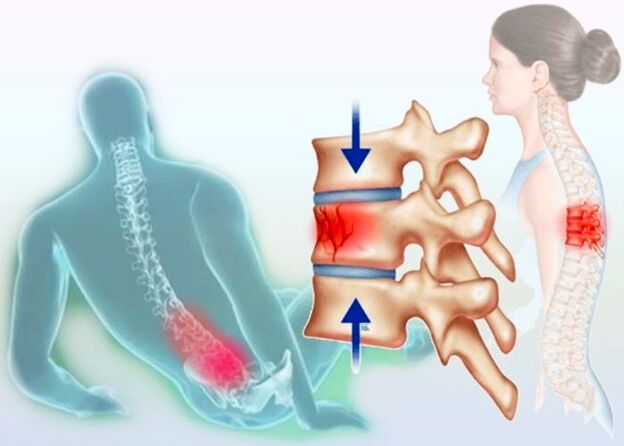 Nawet zwykły uraz może wywołać rozwój osteochondrozy