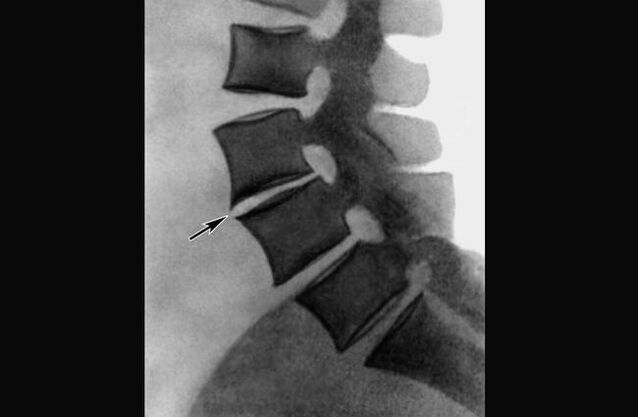 Objawy osteochondrozy kręgosłupa piersiowego na zdjęciu rentgenowskim